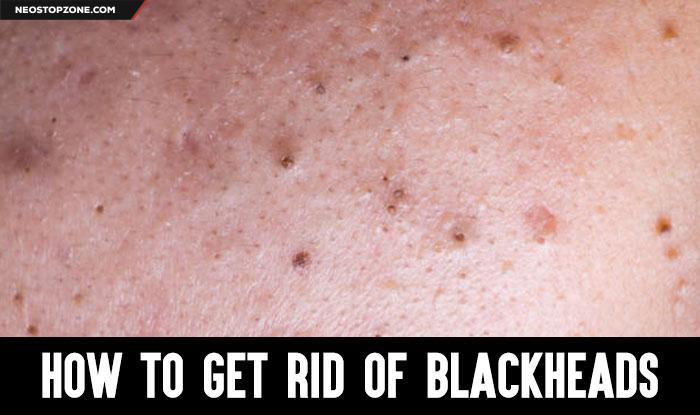 How to Get Rid of Blackheads