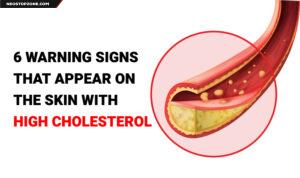 6-Warning-Signs-That-Appear-on-the-Skin-with-High-Cholesterol