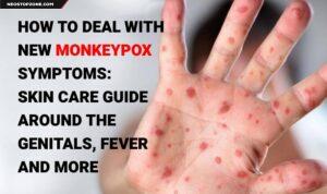 How to deal with new monkeypox symptoms